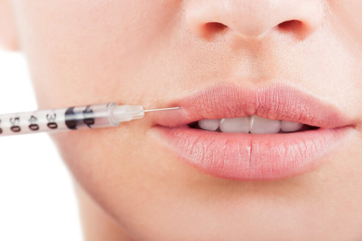 Lip Enhancement by Tammie Mylan Skin Clinic